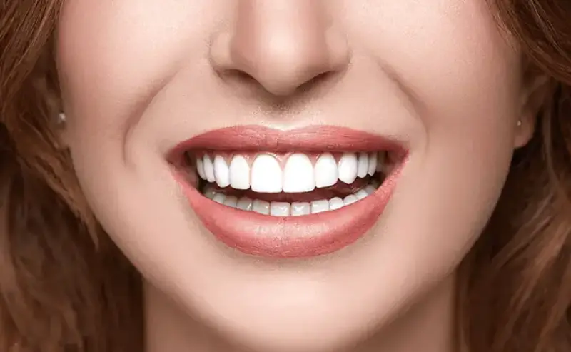 Achieve Perfect Teeth: Dental Veneers In Tucson